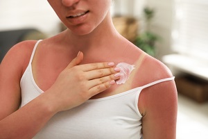 Woman wearing spaghetti-strap camisole applying cream to a beet-red sunburn affecting her upper body